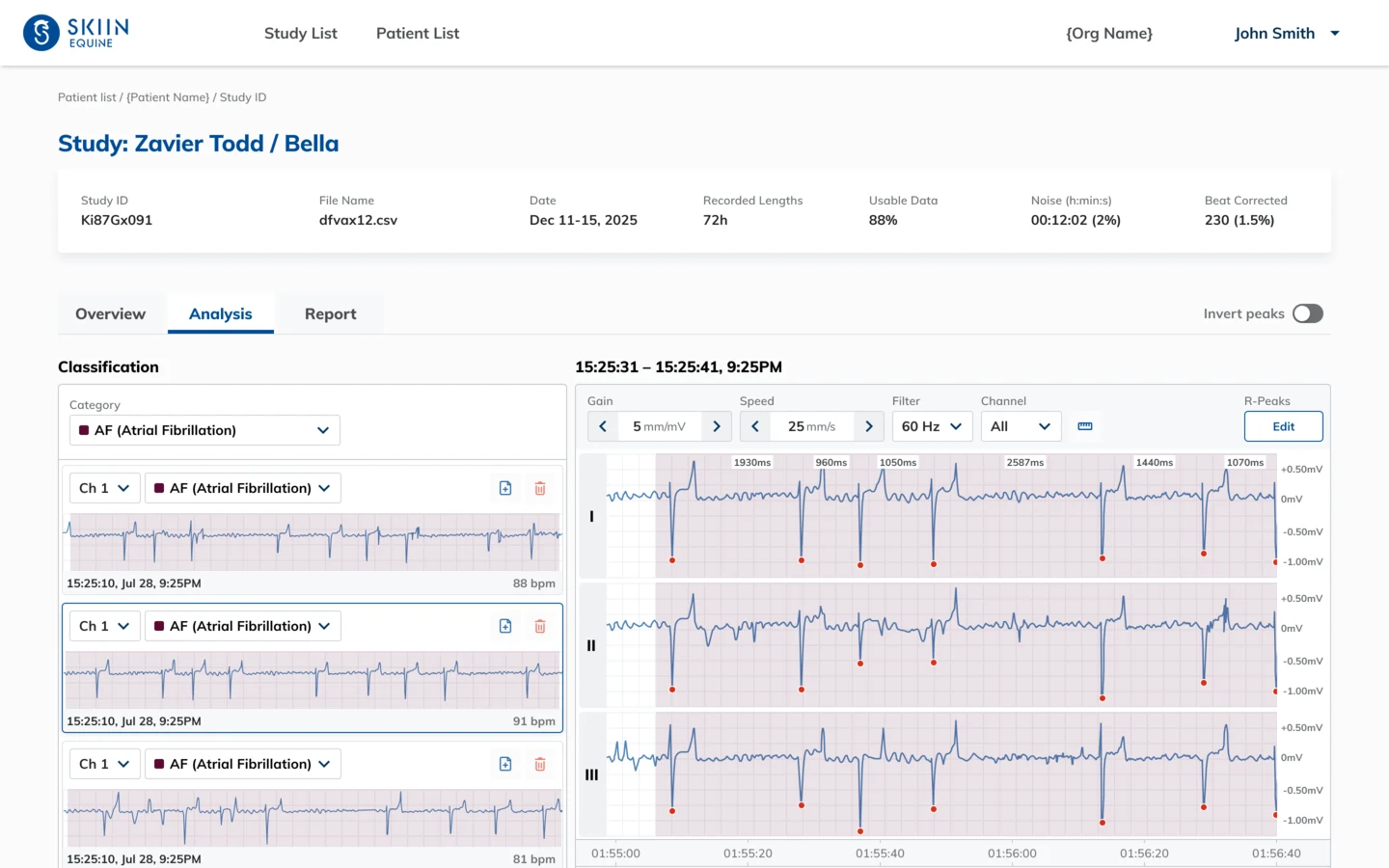 The portal analysis view, with atrial fibrillation flagged across three ECG channels