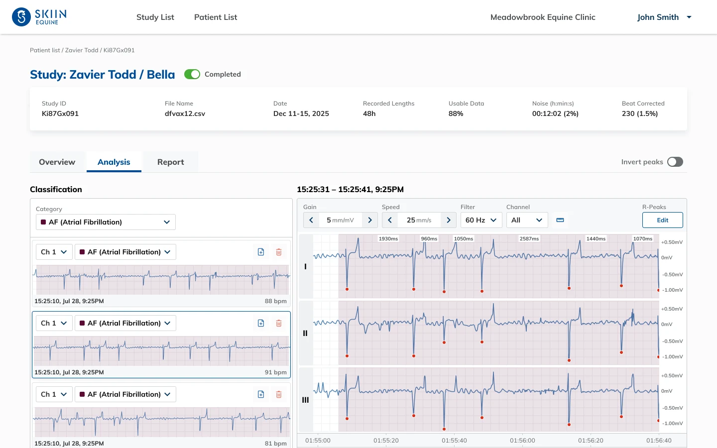 The portal analysis view, with atrial fibrillation flagged across three ECG channels